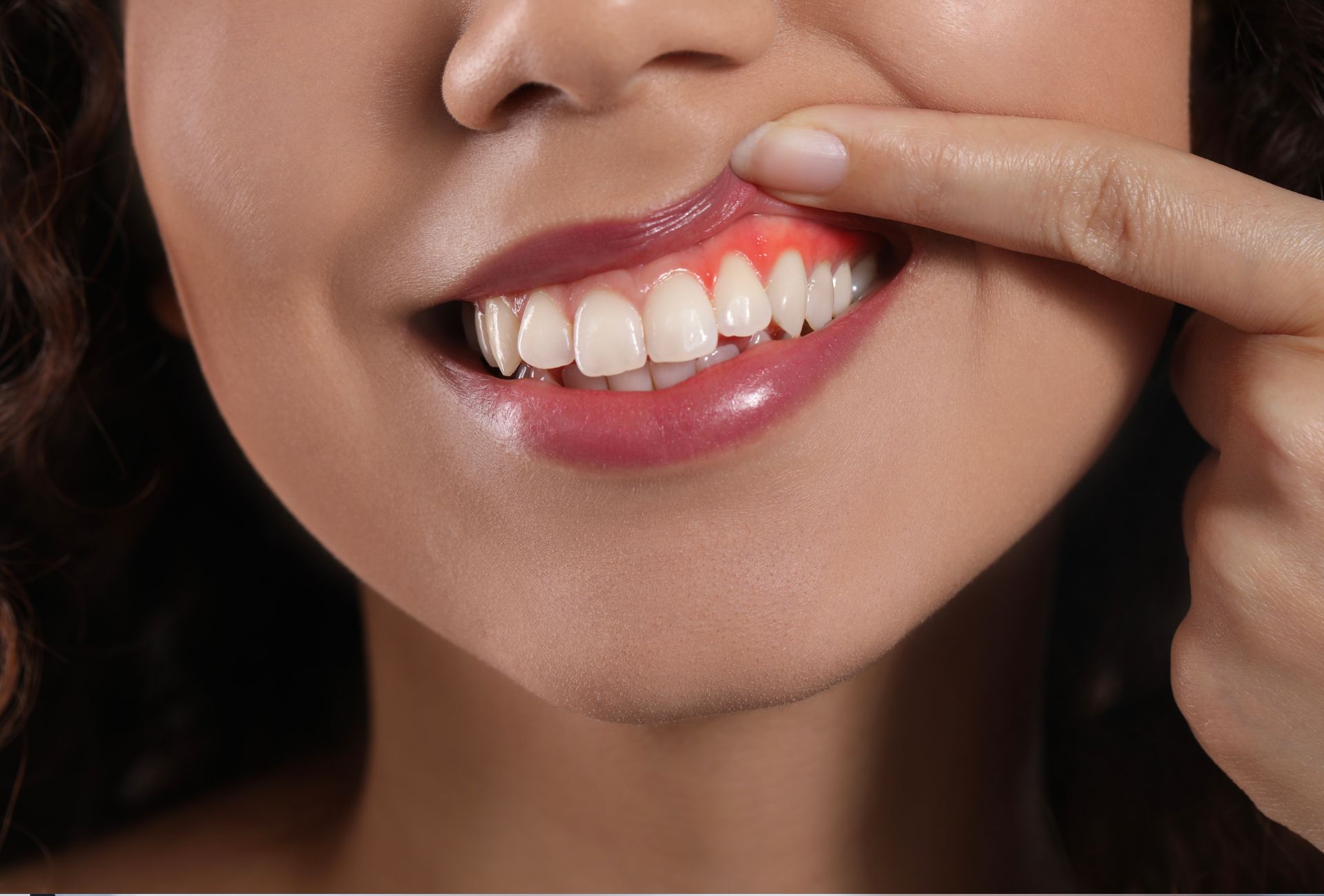 ¿Por qué sangran las encías? Primeros síntomas de alerta que no debes ignorar