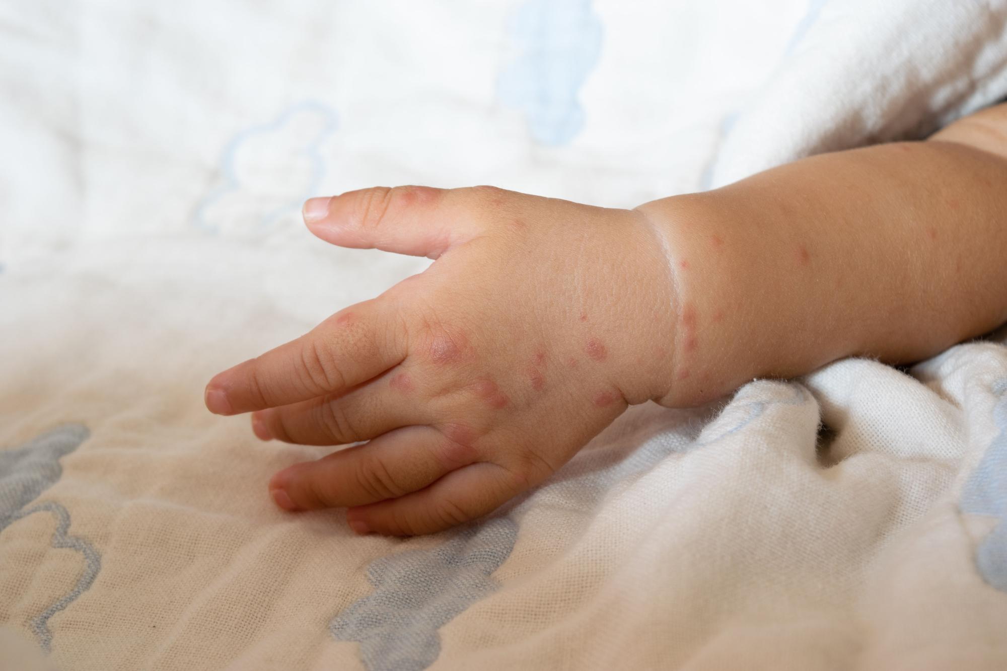Manos, pies y boca: cómo reconocerla y prevenir su propagación en niños