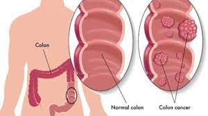 Tres consejos que ayudarán a identificar de forma temprana el cáncer de colon