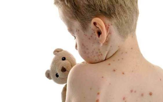 Aumenta a 1,755 los casos de varicela en lo que va del año
