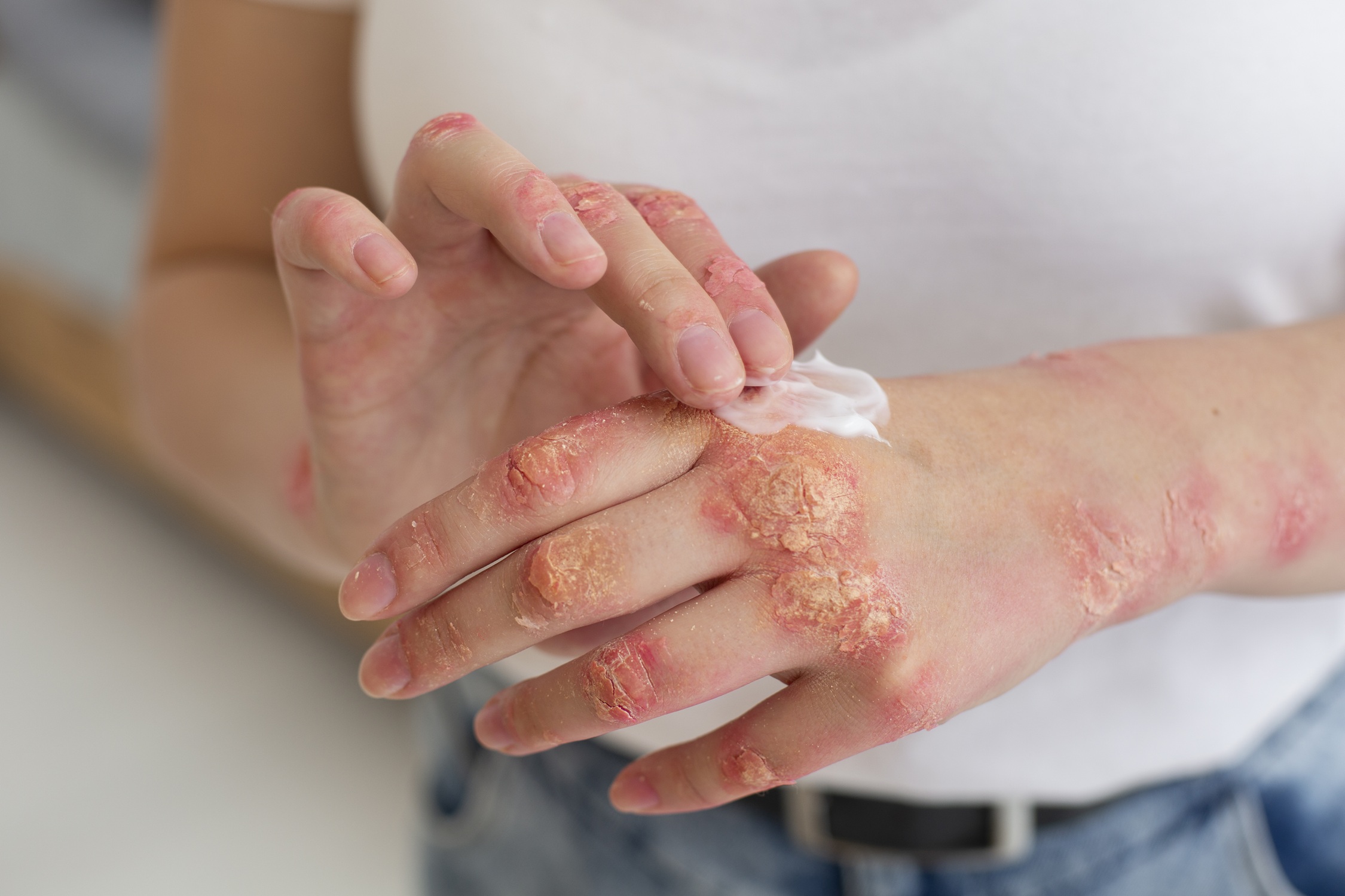 PSORIASIS: 5 FORMAS DE RECUPERAR EL CONTROL CUANDO LA ENFERMEDAD AFECTA TU DÍA A DÍA
