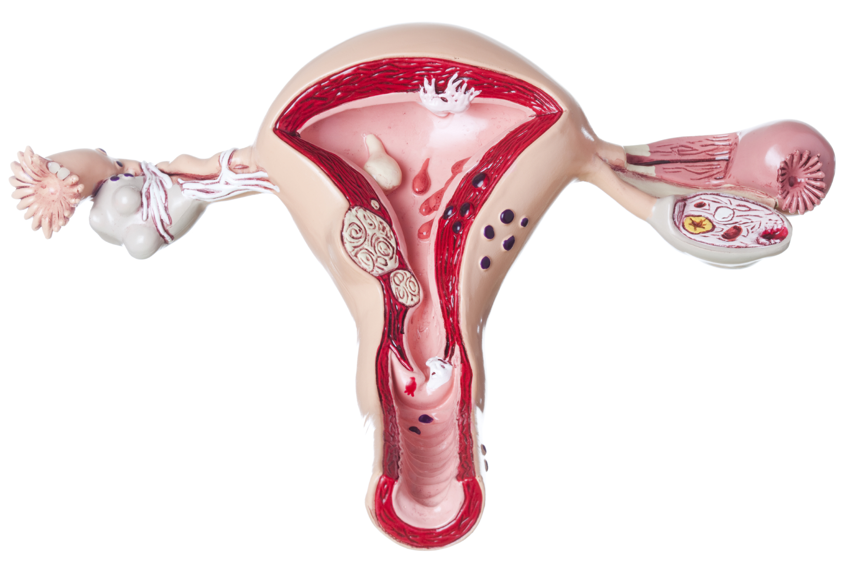 Síndrome de Ovario poliquístico: el enemigo silencioso de la fertilidad femenina