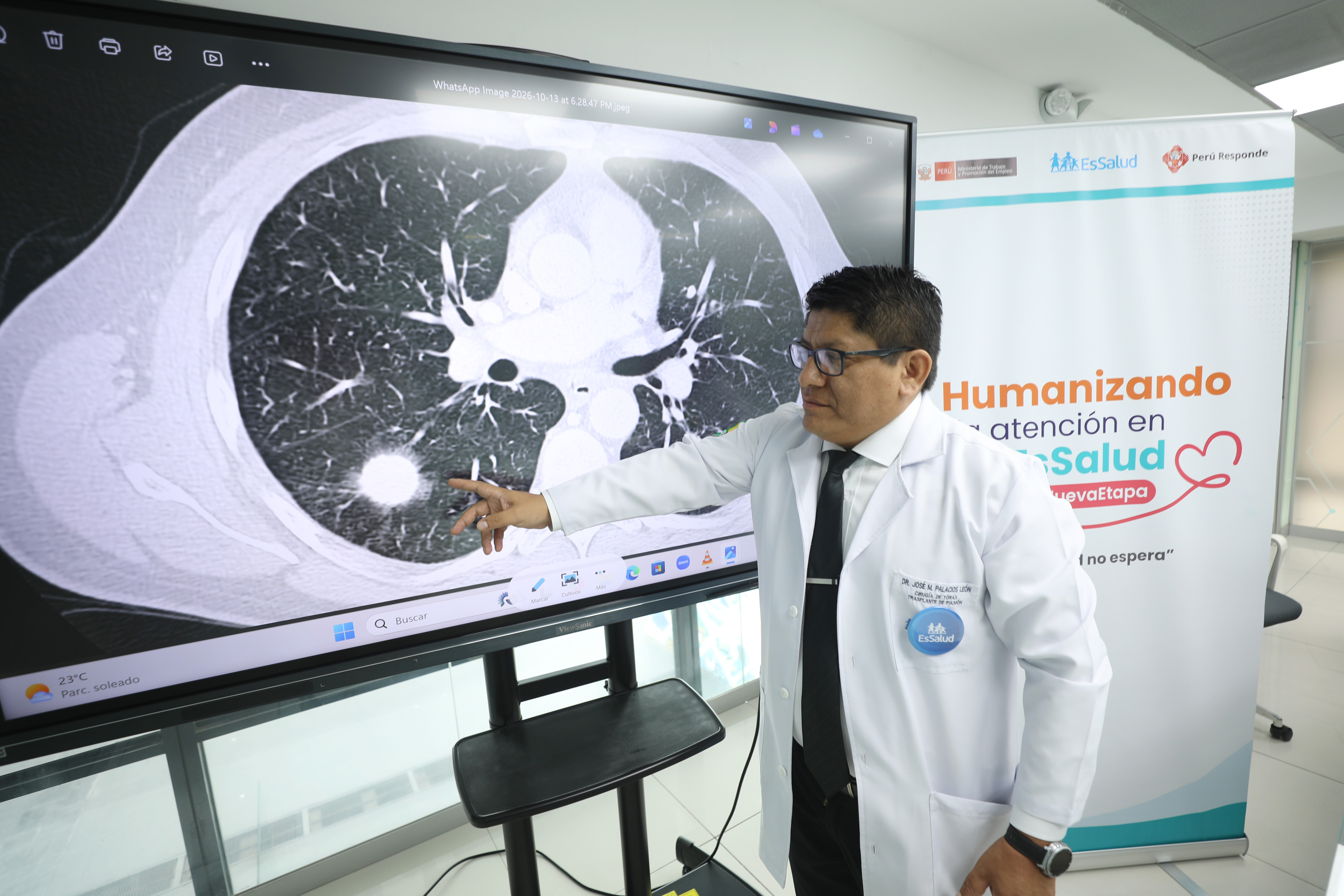 EsSalud explica cómo se diagnostica y trata el adenocarcinoma pulmonar y qué influye en la recuperación
