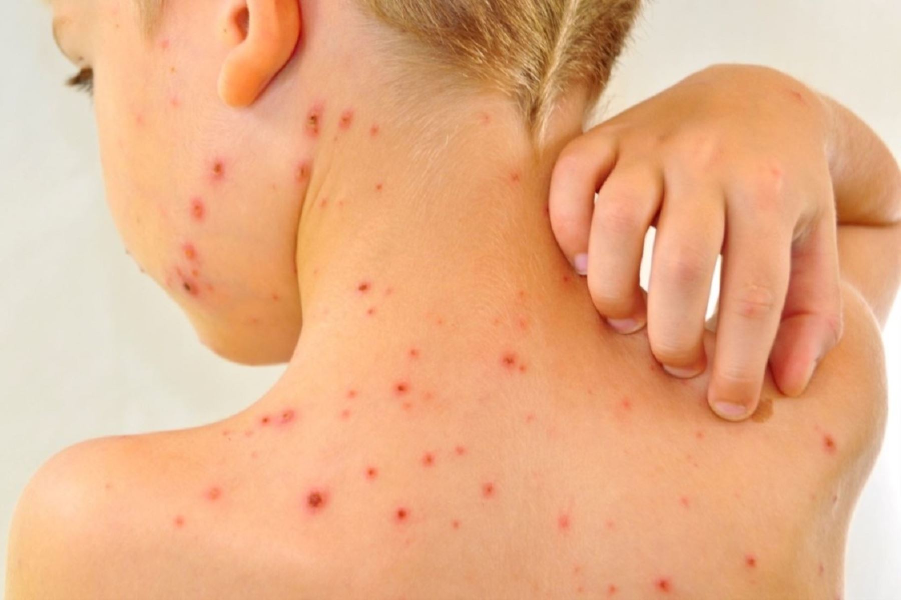 Casos de varicela aumentarían por incremento de temperatura: ¿Qué cuidados debes tener si tu hijo se contagia?