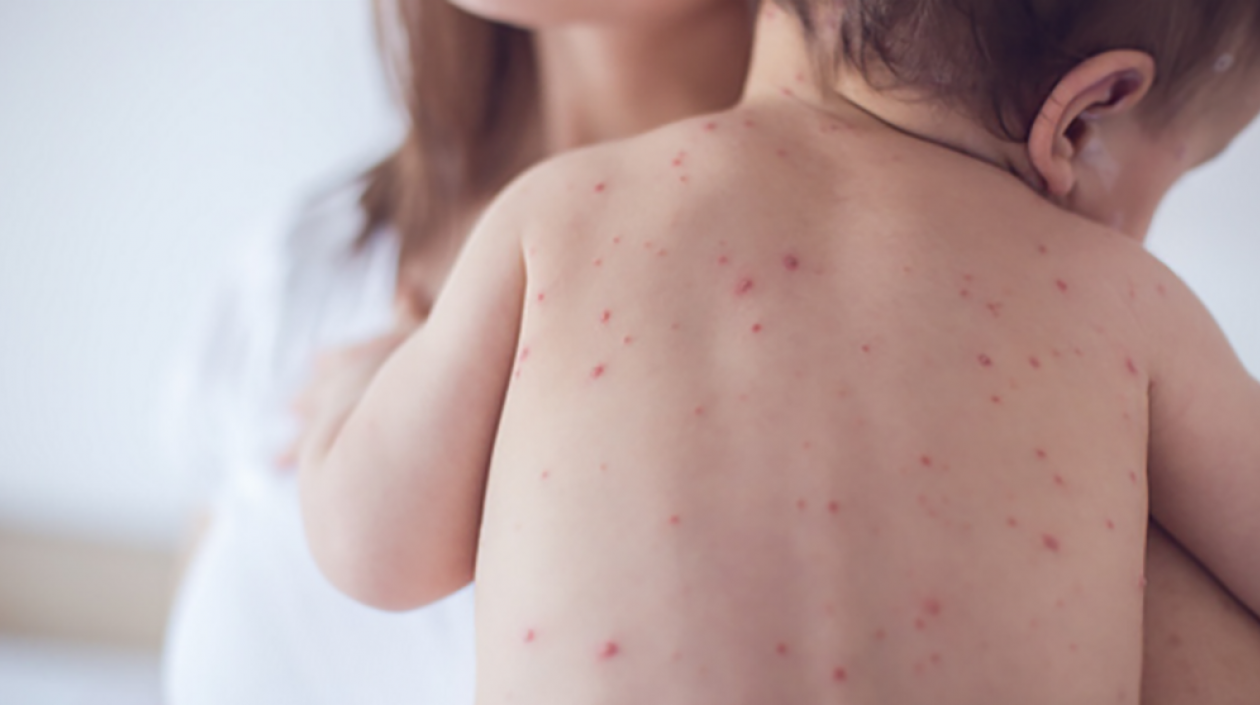¡Cuidado con la varicela! Cambio de estación aumenta casos a nivel nacional