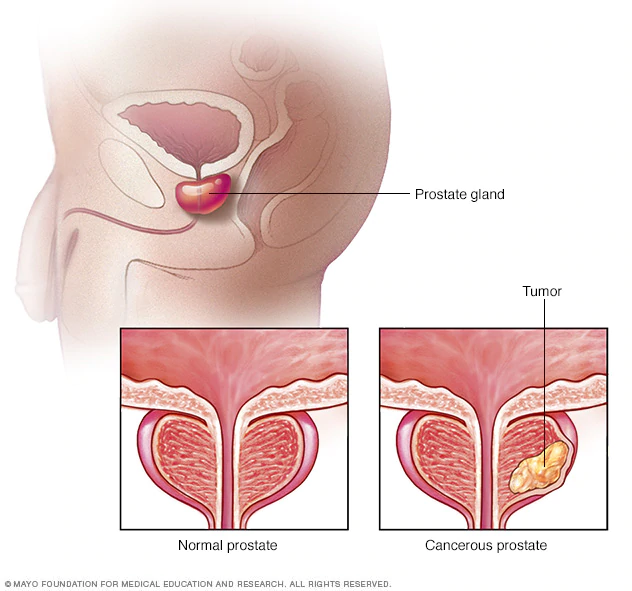 Se estima que el 67% de los hombres que presentan cáncer de próstata son mayores de 65 años