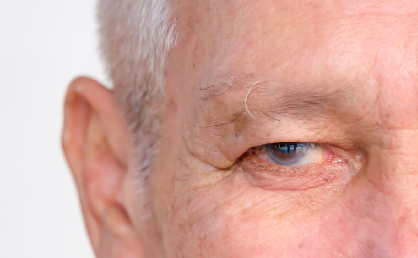 ¿Sabes cómo detectar el glaucoma?: Puntos claves para conocerlo y frenarlo