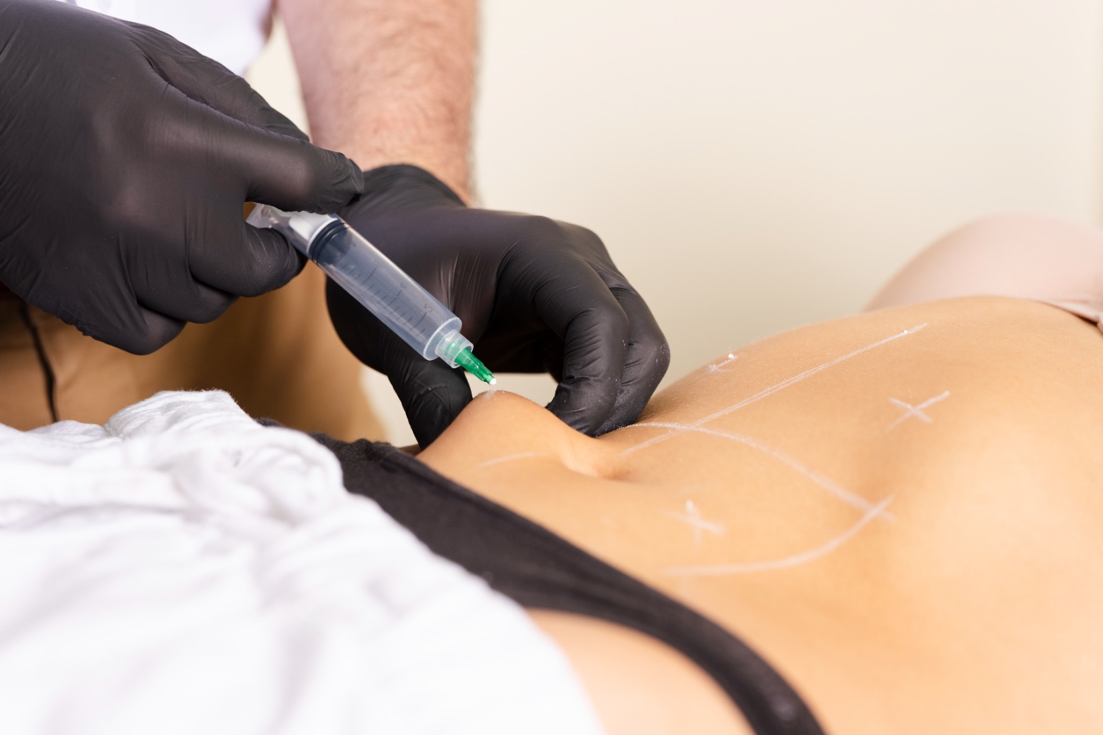 Fibrosis corporal: ¿cómo identificarla y qué tratamientos ayudan a reducirla?