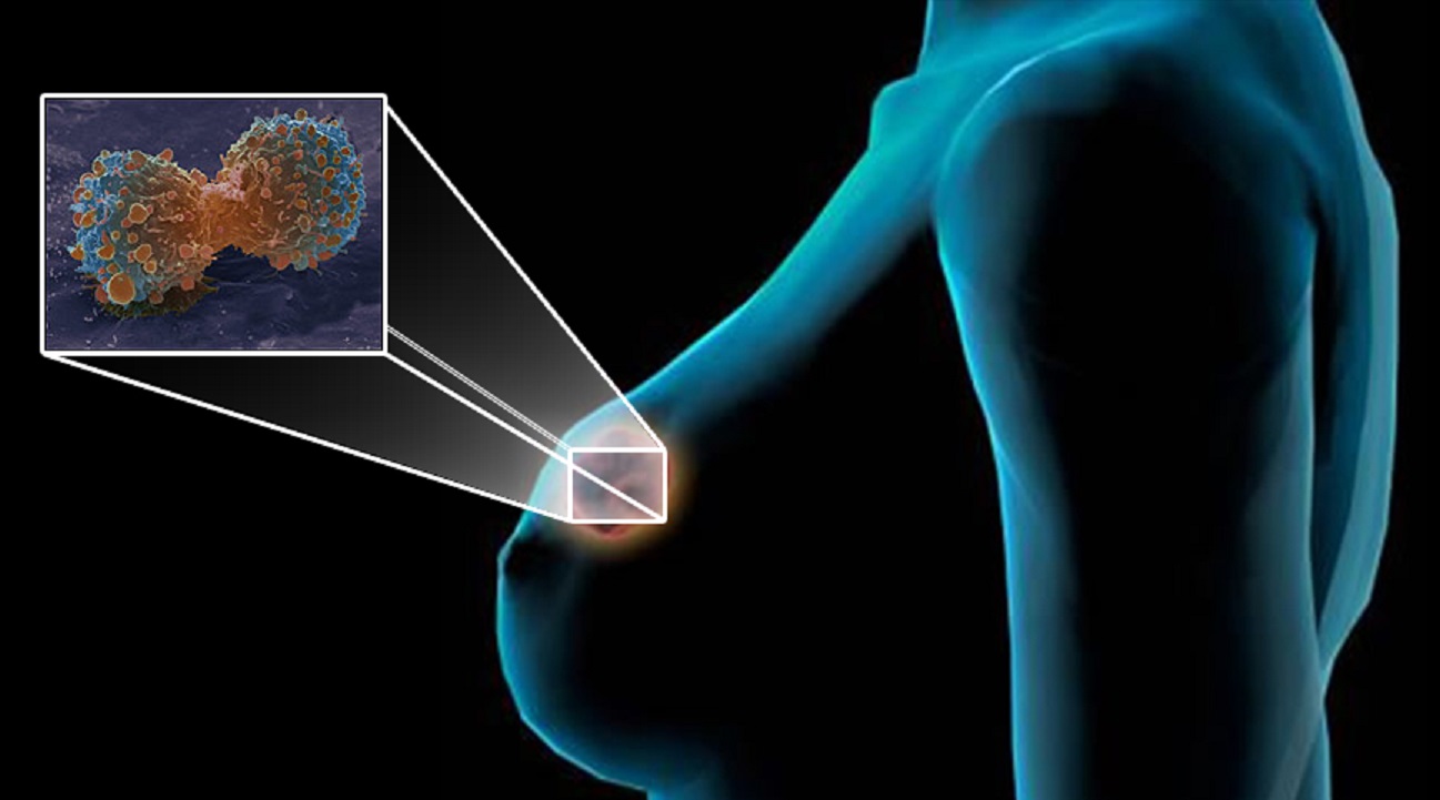 Próstata y mama: los tipos de cáncer con mayor incidencia en el Perú