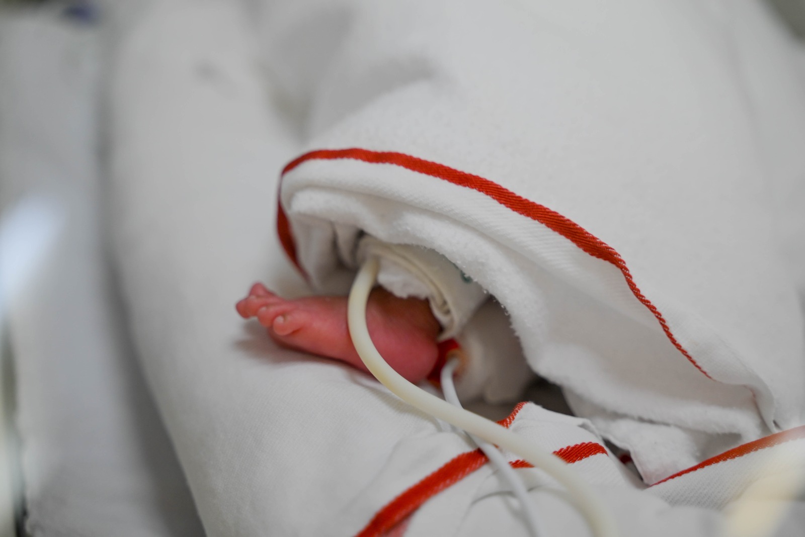 ¡Proeza médica! Especialistas del INSN Breña salvan a una bebé prematura de un kilo tras compleja cirugía para extraerle un catéter incrustado