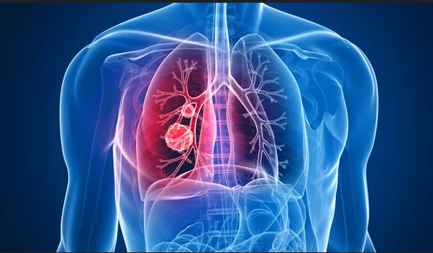 El diagnóstico temprano y los avances significativos en el tratamiento podrían reducir la alta tasa de mortalidad de cáncer de pulmón
