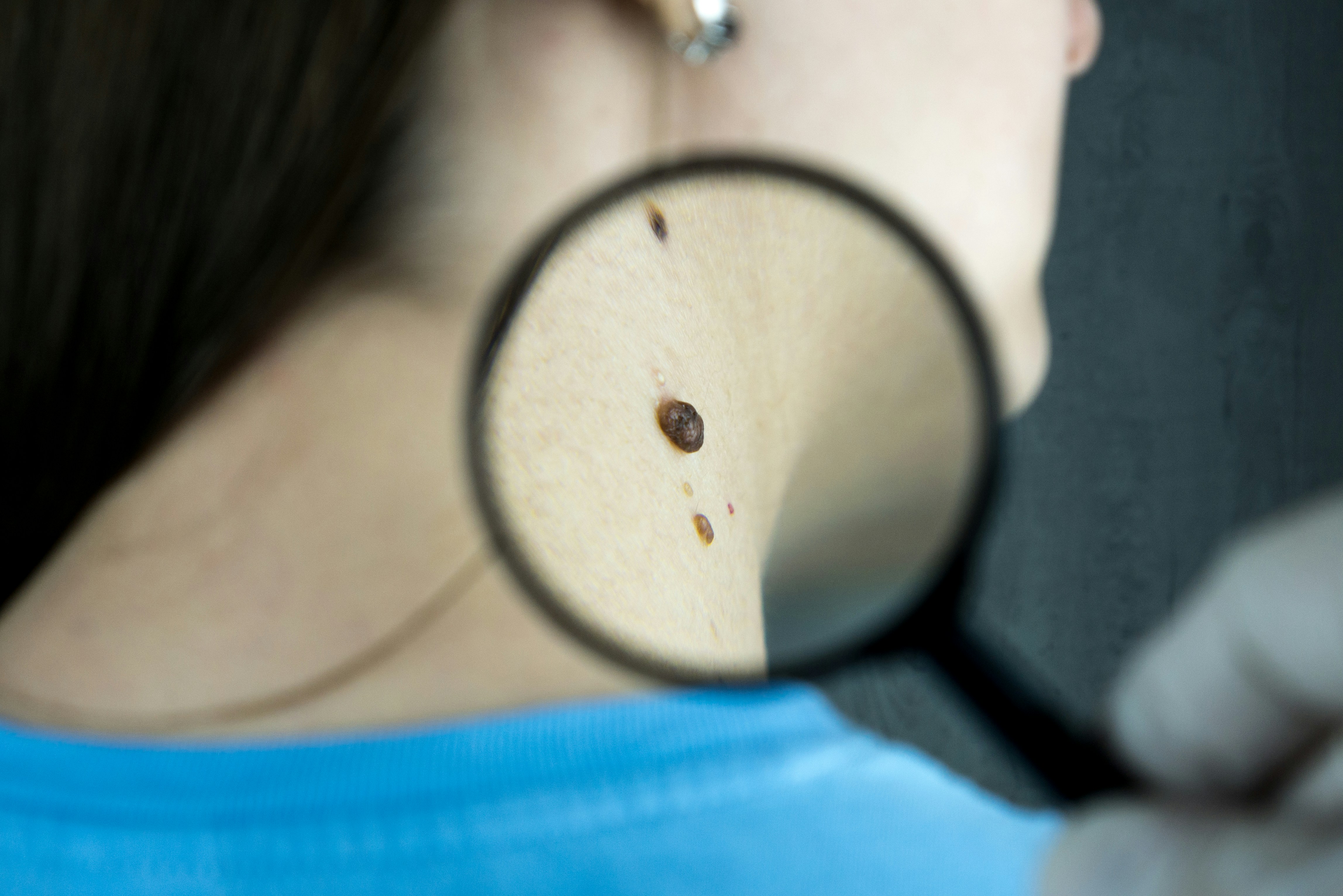  Día Mundial del Cáncer de piel: más de la mitad de los casos de melanoma se detectan en etapas avanzadas