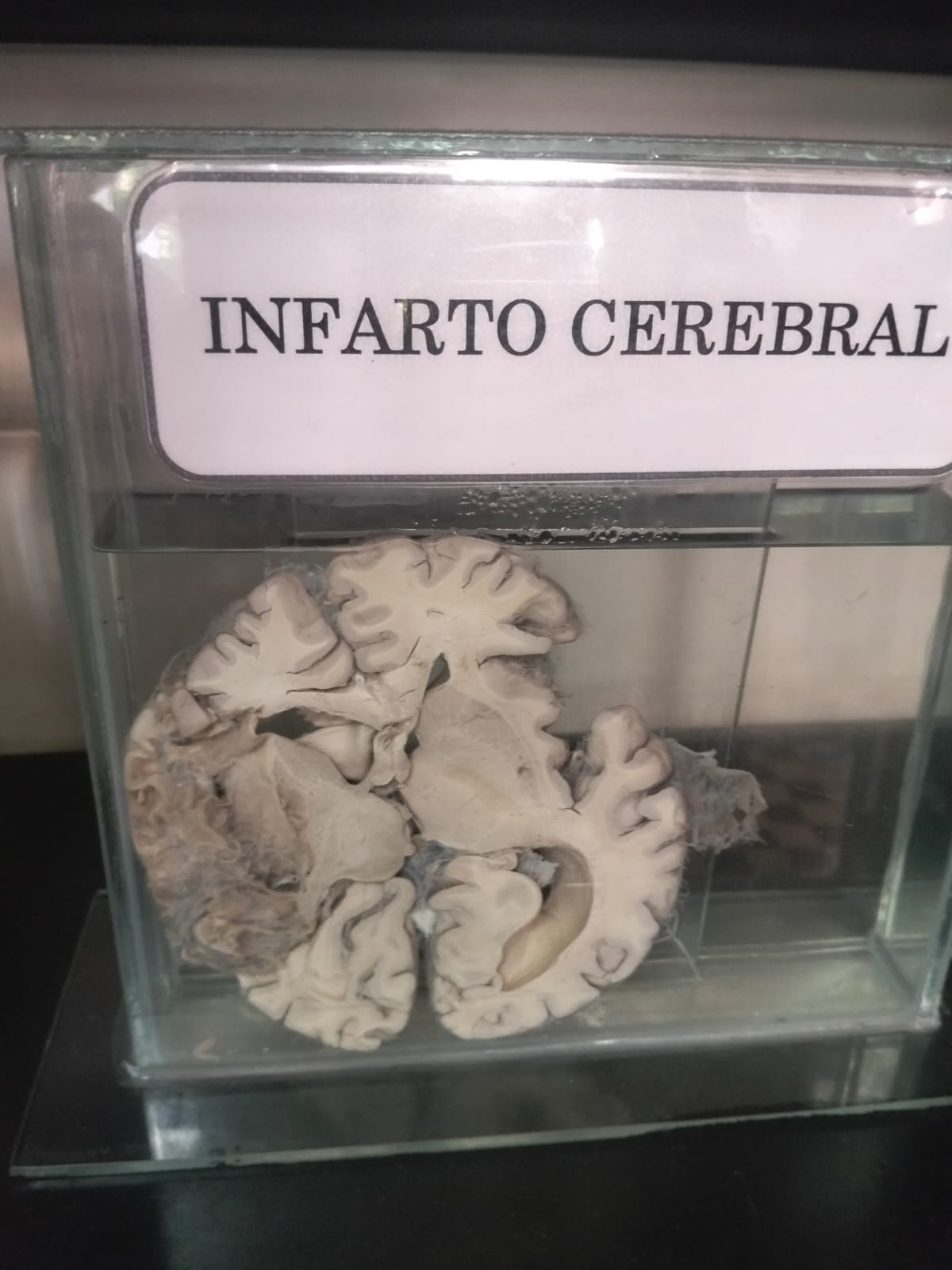 Museo del Cerebro: Vasta colección permite visualizar los deterioros y daños irreversibles que sufre nuestro órgano al no tener el cuidado adecuado.