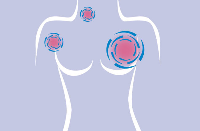 ¿Qué tan rápido se propaga el cáncer de mama?