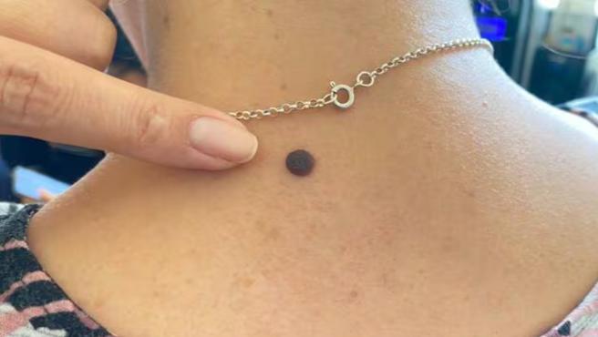 Minsa recomienda la detección temprana de lunares sospechosos para descartar cáncer de piel