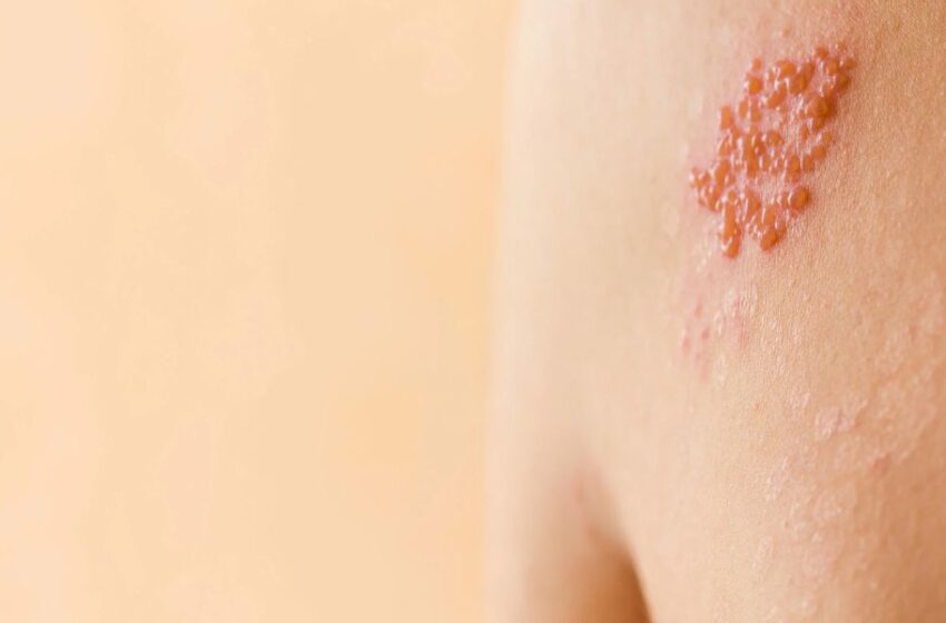 Siete mitos y verdades sobre el herpes zóster