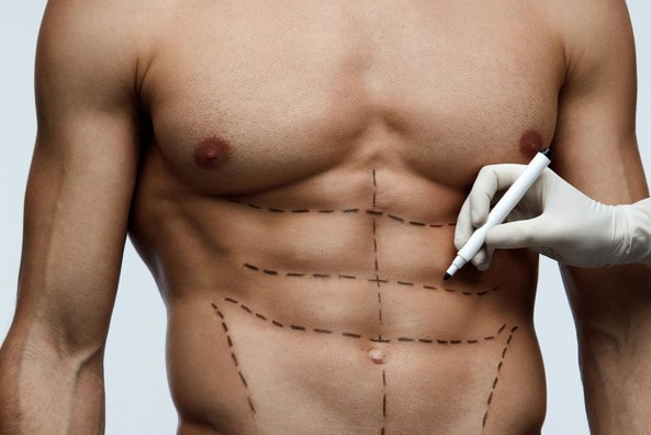 Cirugía estética: ¿Qué es y cuáles son los beneficios de la liposucción en HD?