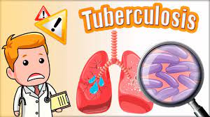Día Mundial contra la Tuberculosis: enfermedad se incrementa por mala alimentación