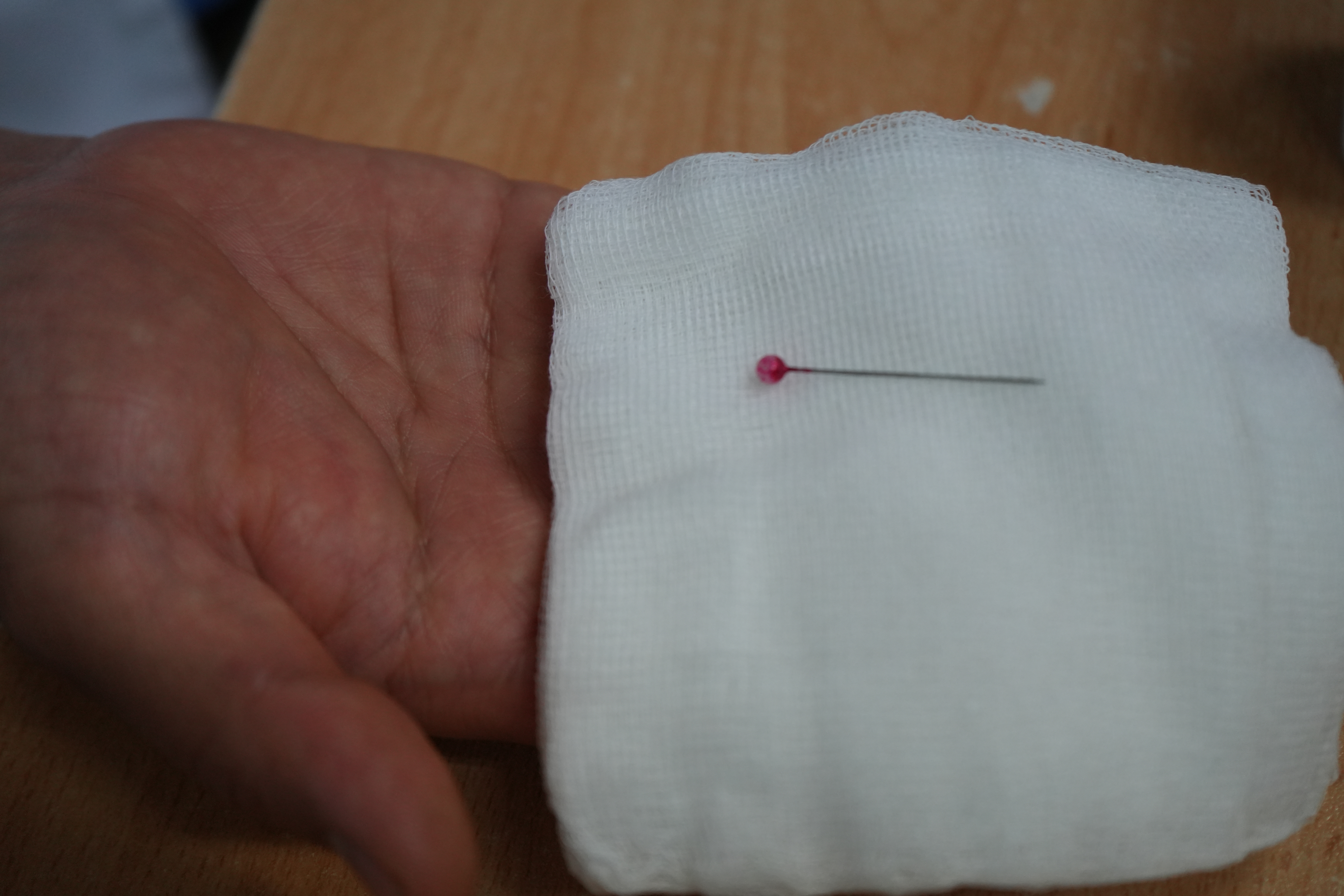 EsSalud: Niña de 2 años disfrutará Navidad luego de que en el Hospital Almenara le retiraran un alfiler alojado en su vía aérea