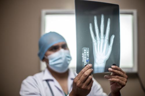 ¿Te fracturaste con una caída leve? Podría ser una señal de osteoporosis
