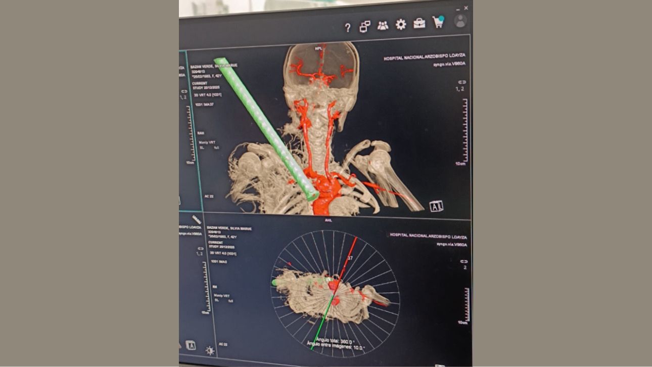 Minsa: médicos del Hospital Arzobispo Loayza extraen con éxito fierro incrustado en supraclavicular derecha de mujer de 42 años