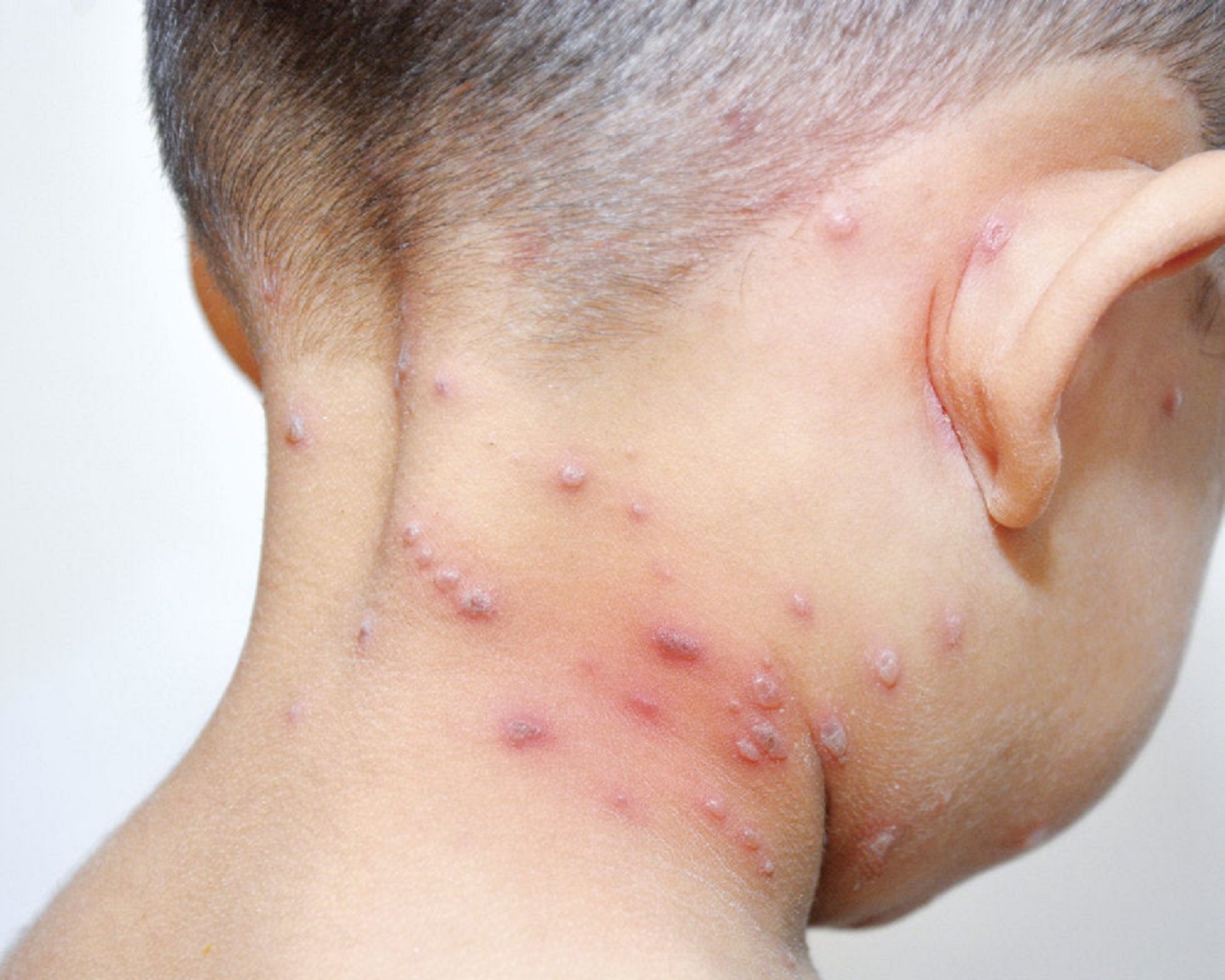 Alerta: Cerca de 20 casos de varicela se presentan en la región La Libertad