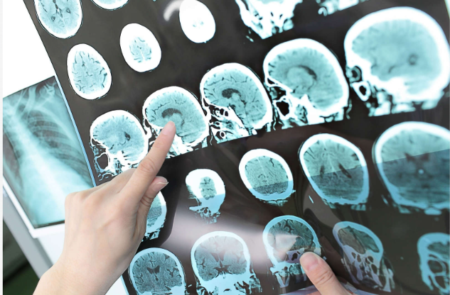 Tumores cerebrales: ¿Cómo detectarlos a tiempo y cómo evitarlos?