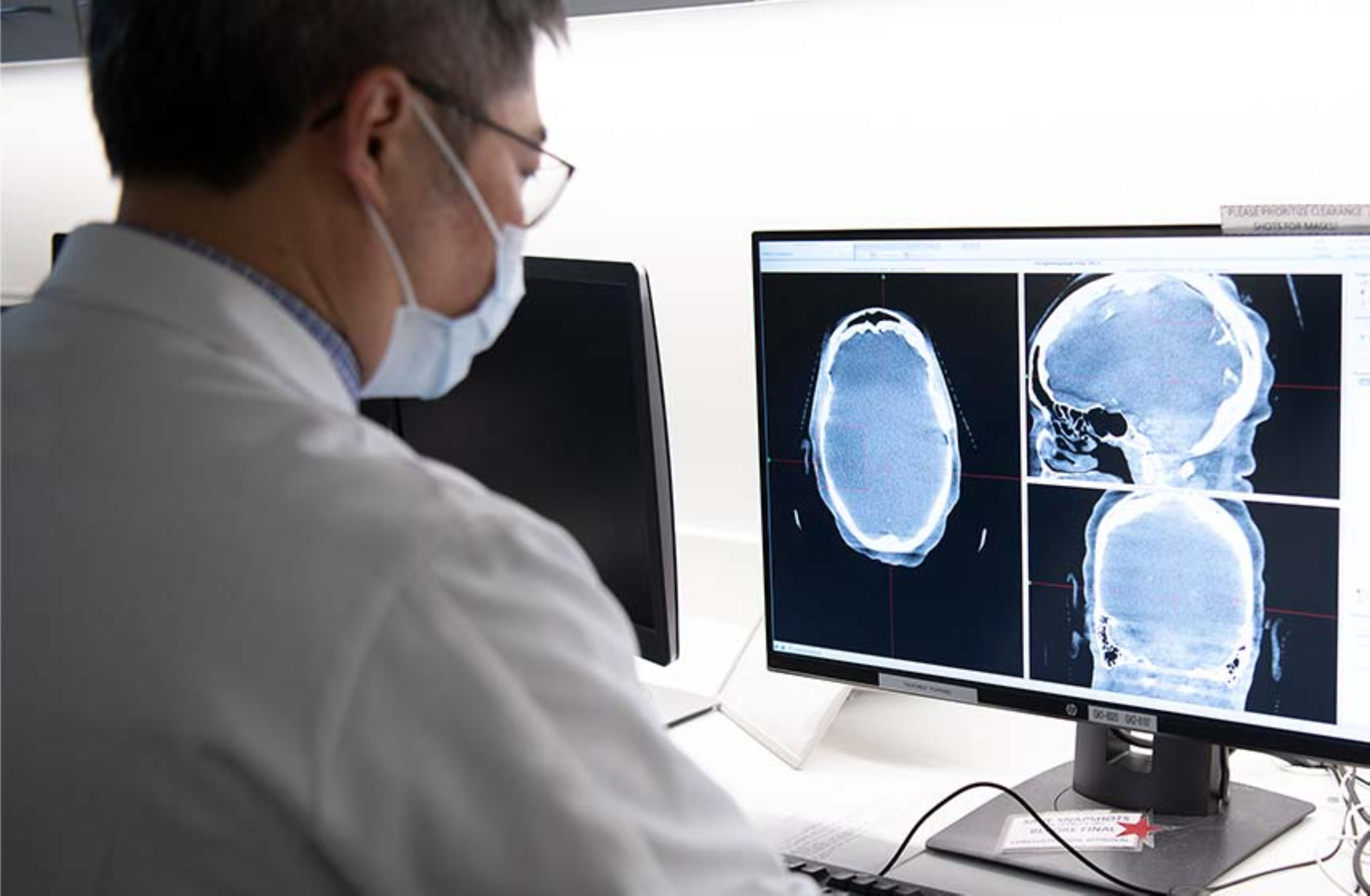 Meningioma, el cáncer cerebral que más afecta a adultos y que pocos conocen