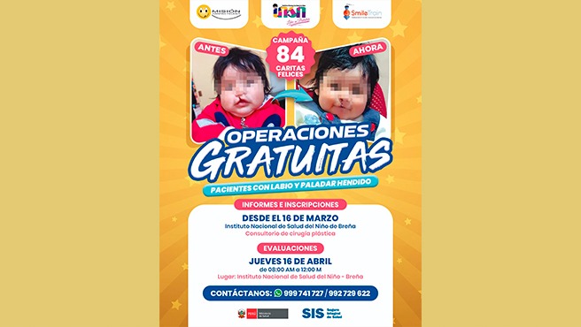 Minsa convoca a familias a inscribir a niños para acceder a 80 cirugías gratuitas de labio fisurado y paladar hendido