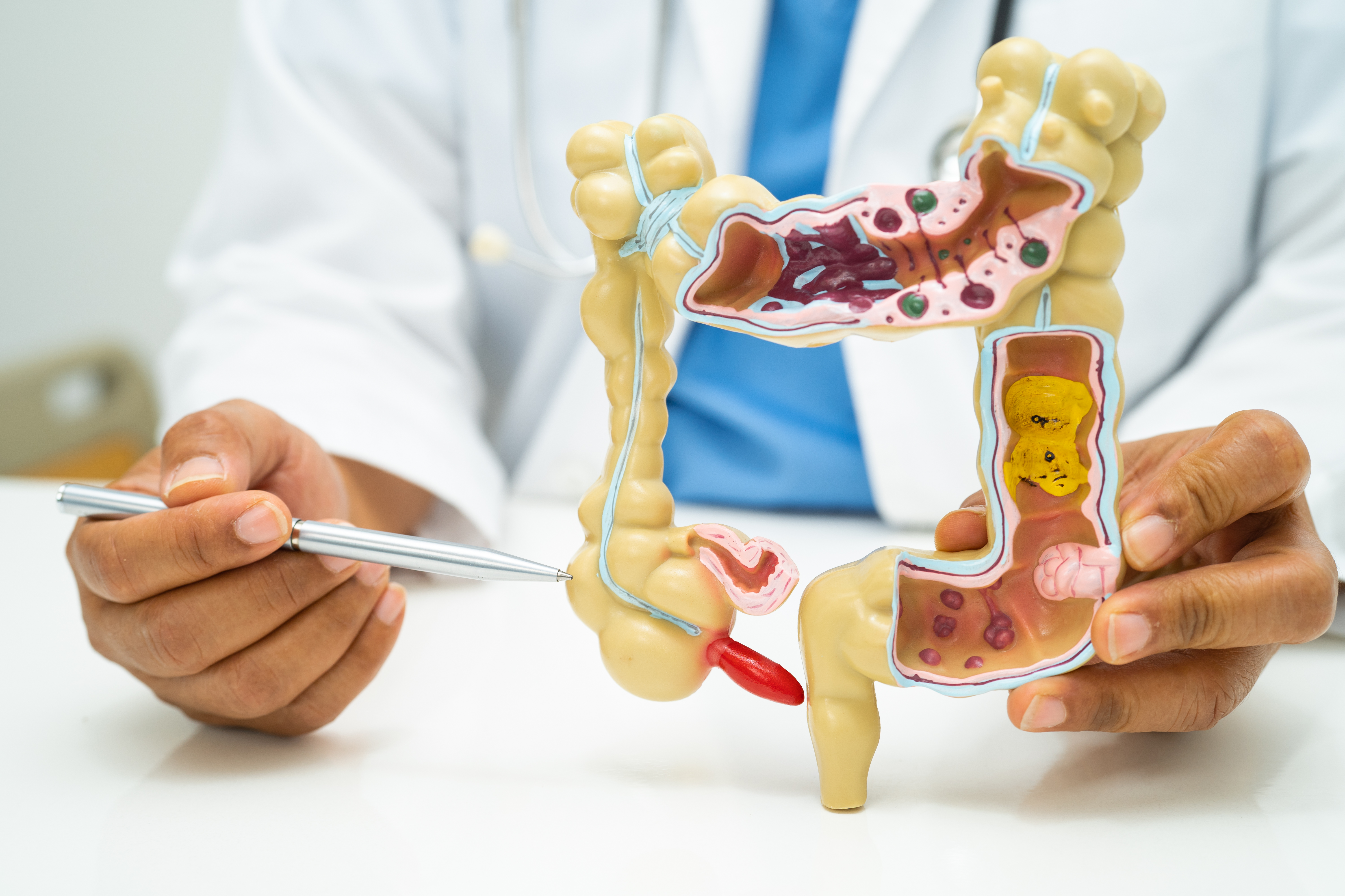 Cáncer de colon: ¿por qué la diarrea o el estreñimiento no deben ignorarse?