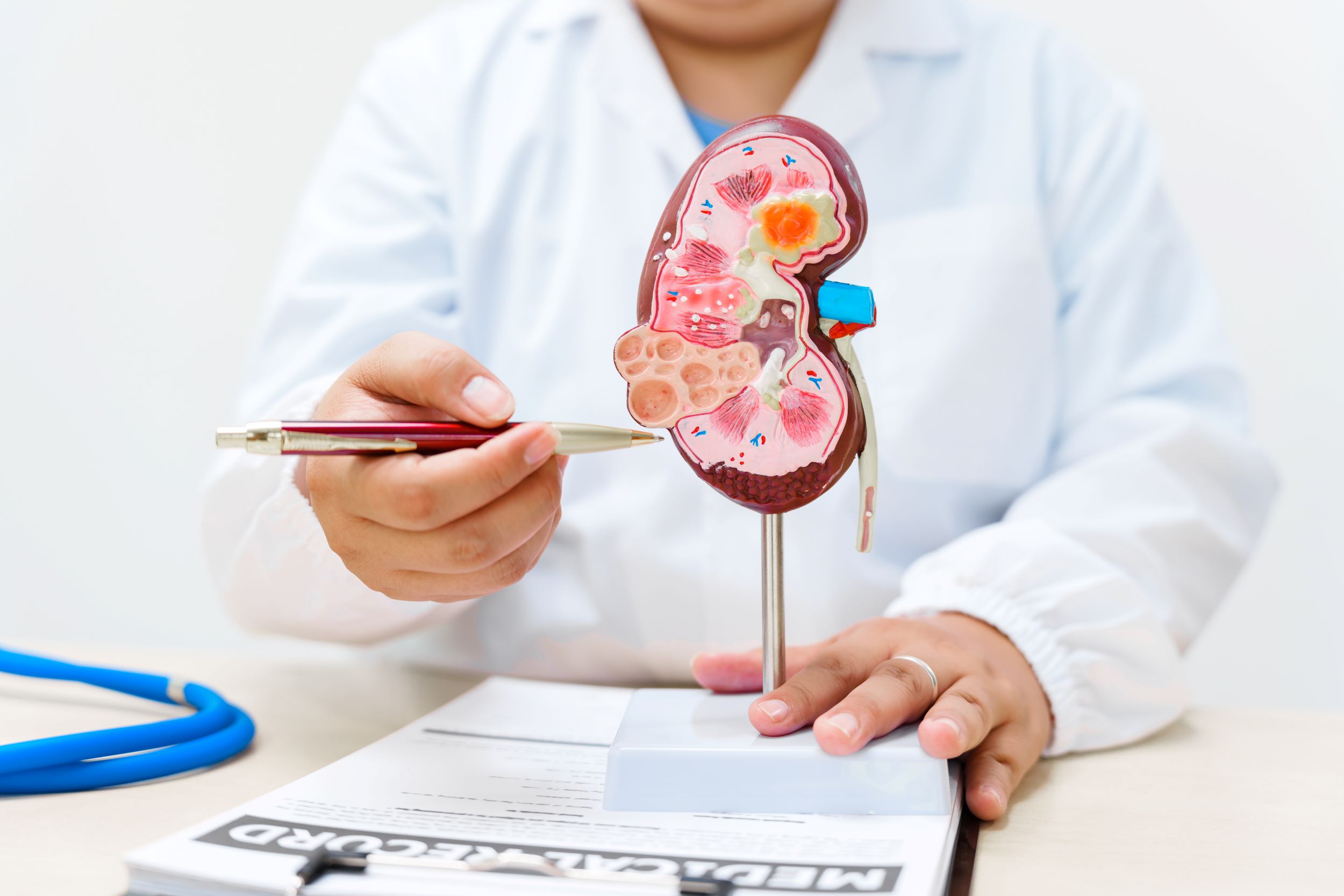 Cáncer renal: Prevalencia, síntomas, factores de riesgo y tratamientos