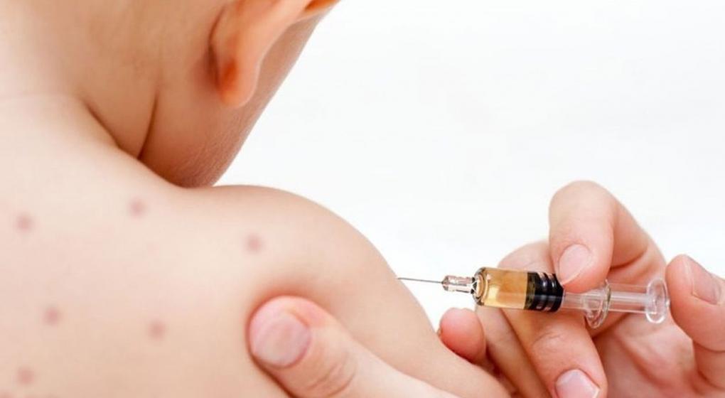 Sarampión: La vacunación como principal medida para evitar el contagio 
