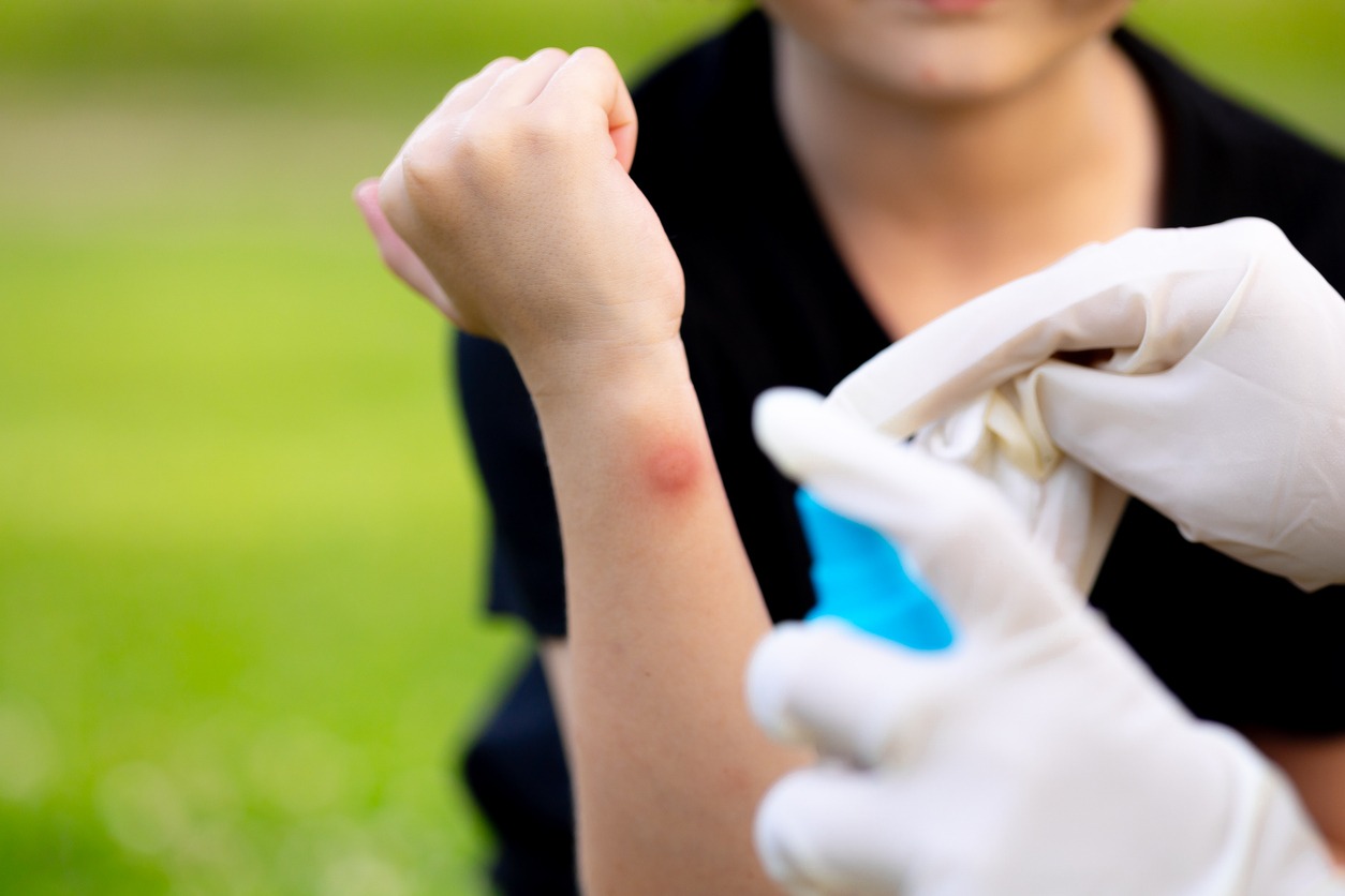 Semana Santa: qué hacer ante golpe de calor, picaduras y ahogamiento leve