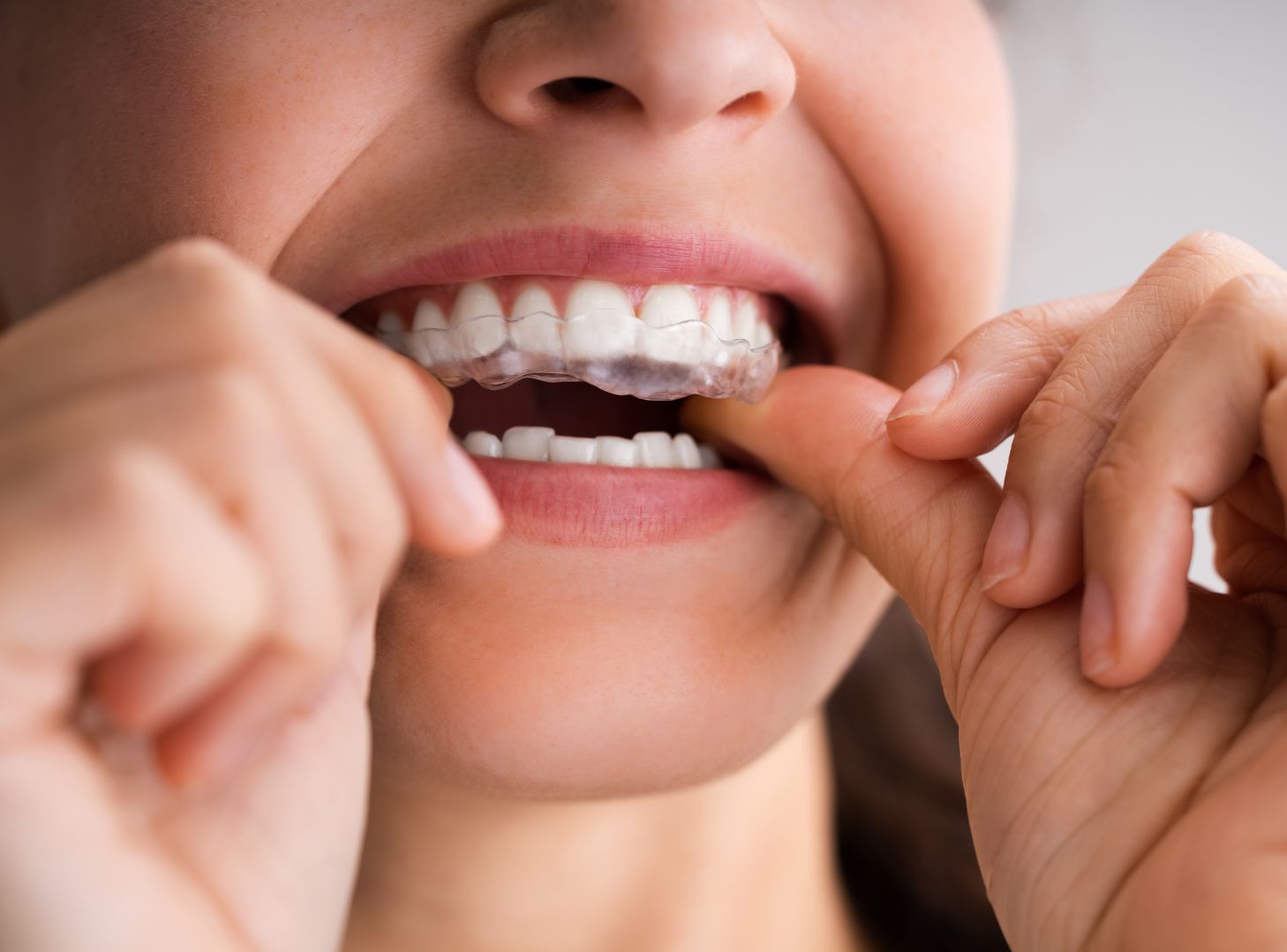 ¿Sabías del bruxismo diurno y nocturno? Ambos podrían estar fracturando tus piezas dentales