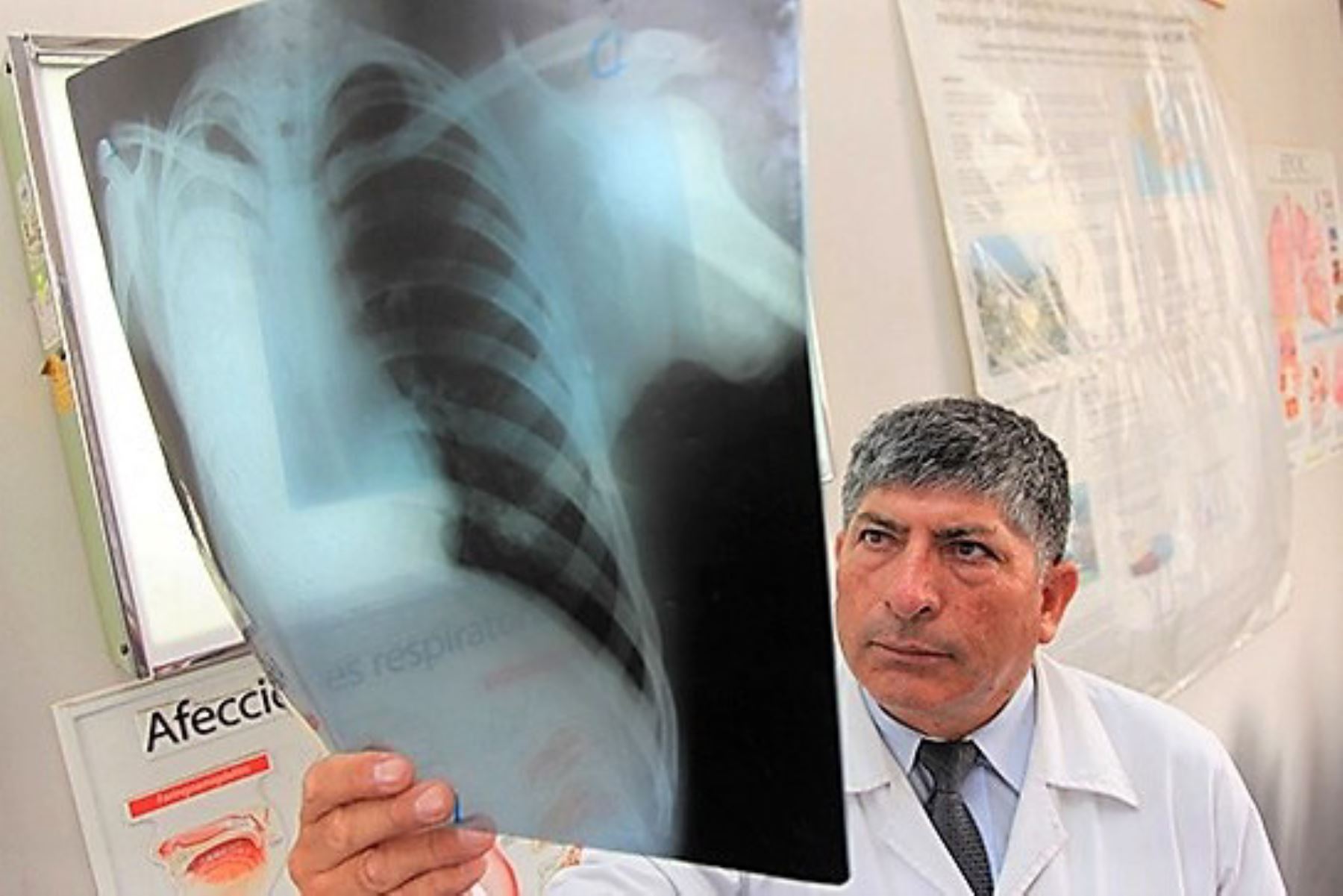 Fibrosis pulmonar idiopática es más frecuente en adultos a partir de los 50 años