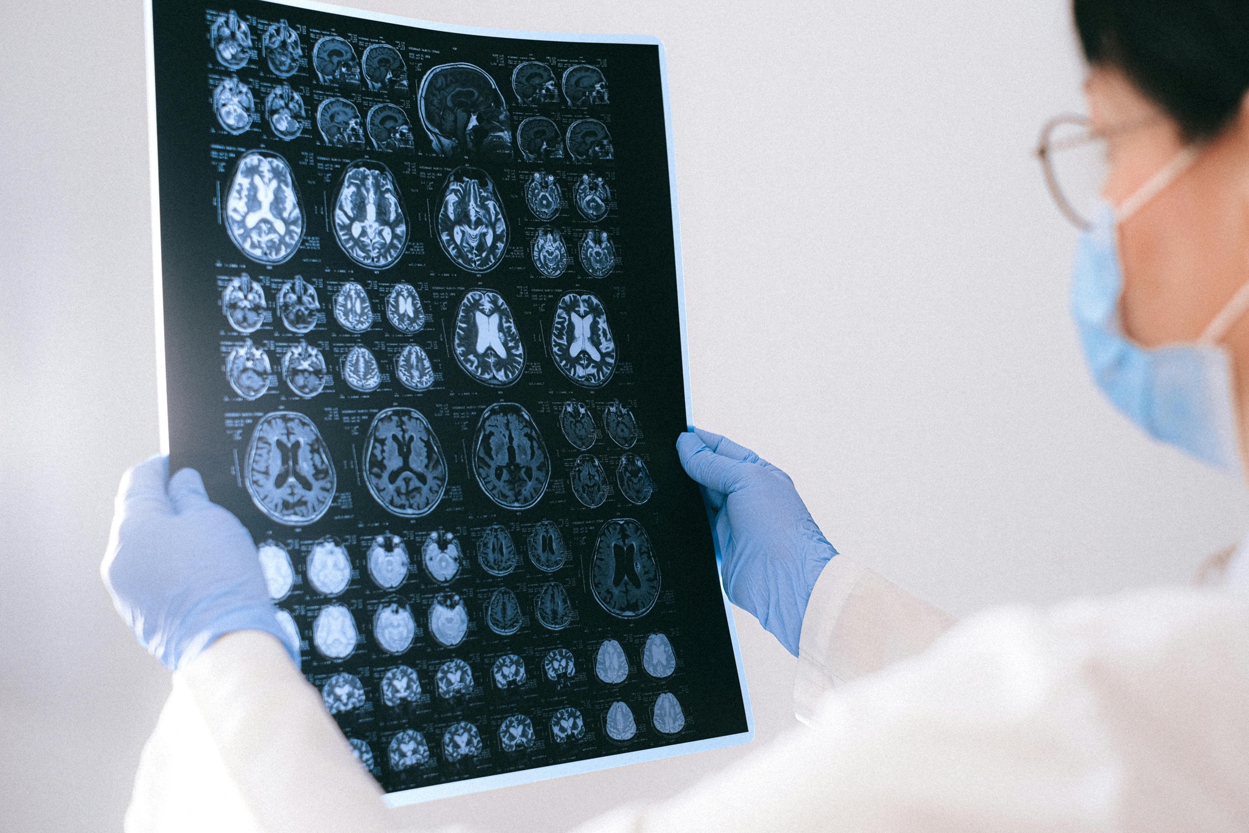 Estudio vincula el exceso de hierro en la dieta con daño cerebral