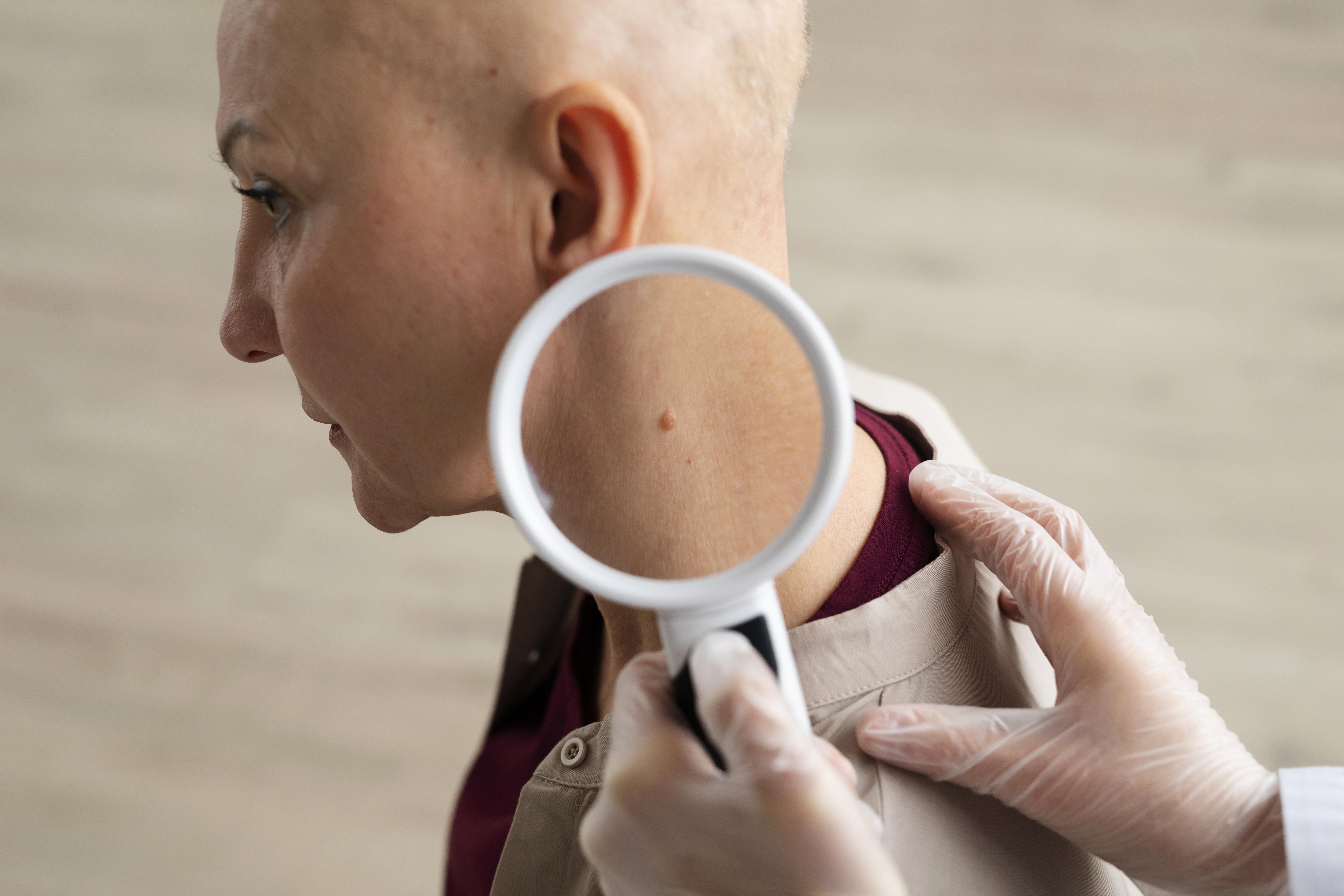 El verano y el cáncer de piel: ¿Sabes cómo cuidarte?