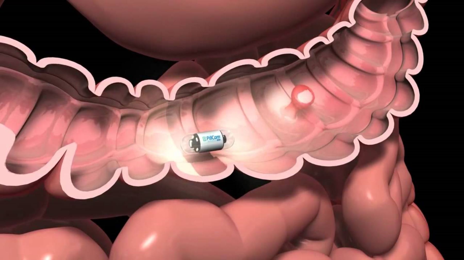 Cáncer de colon y recto detectado a tiempo es altamente curable