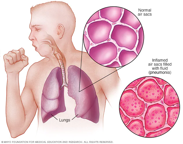 La Neumonía: Enfermedad Prevenible Mediante La Vacunación Semana Epidemiológica 15, Región Lima: Casos 9087, muertes 249