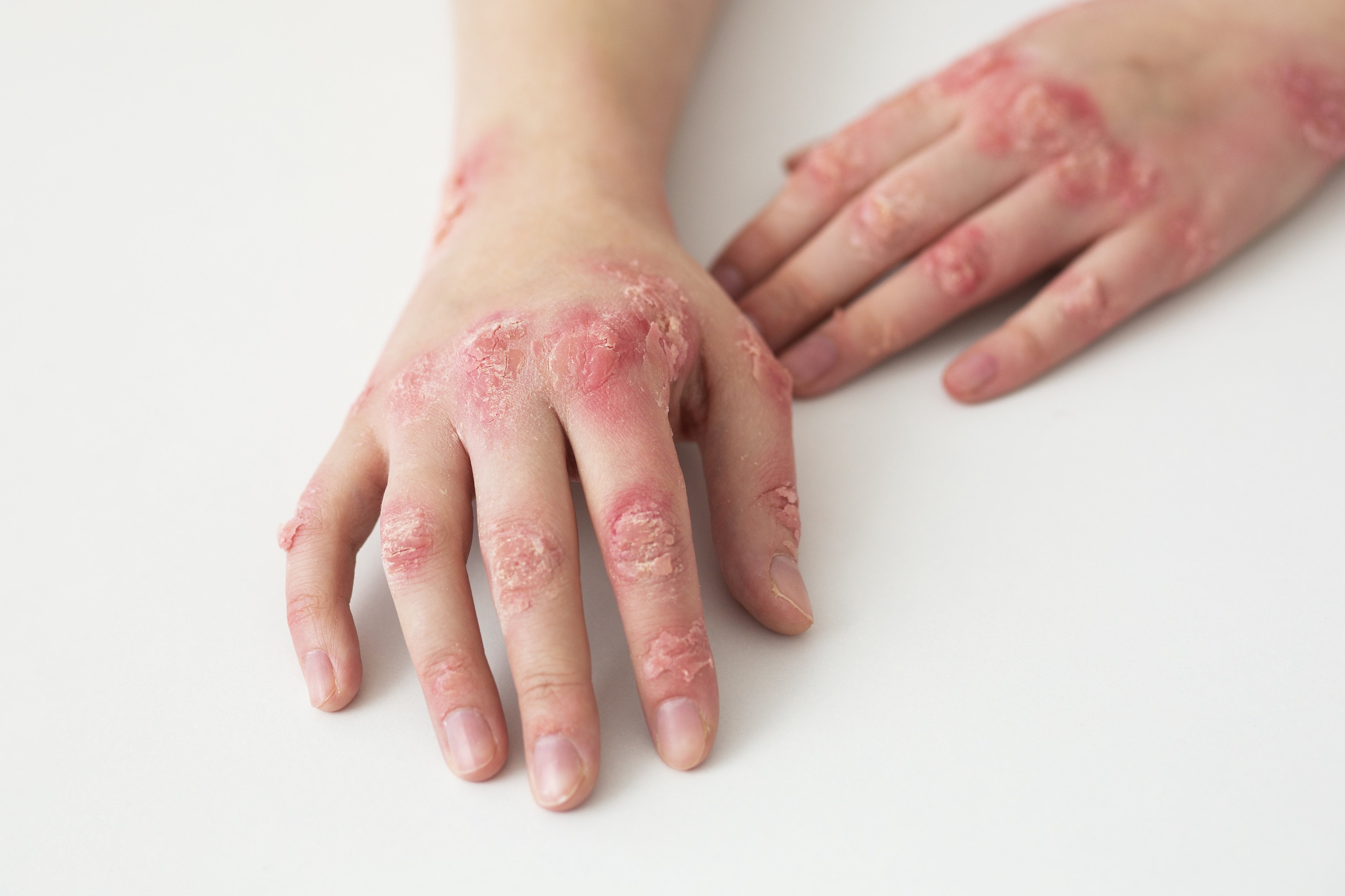 Día Mundial de la Psoriasis: 5 consejos para controlar los brotes y vivir con confianza