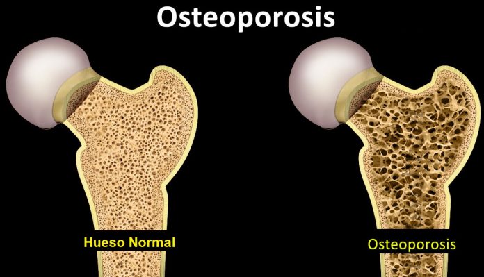 OSTEOPOROSIS: CUIDADOS Y PREVENCIÓN