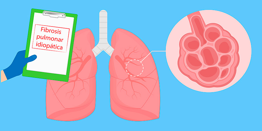 Cómo identificar la fibrosis pulmonar, una enfermedad silenciosa