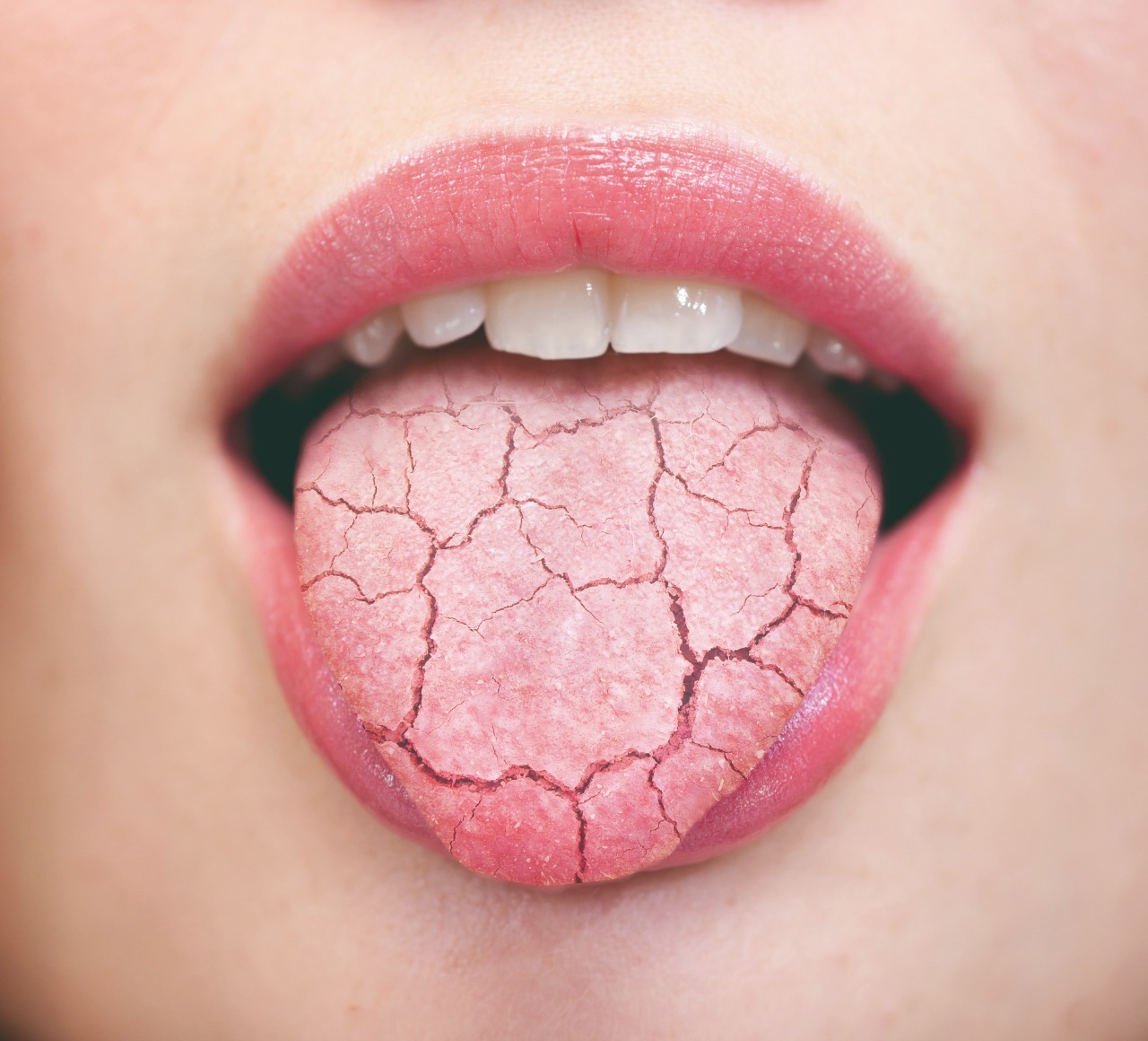 La boca seca es un síntoma que aparece hasta en la mitad de los pacientes con COVID-19
