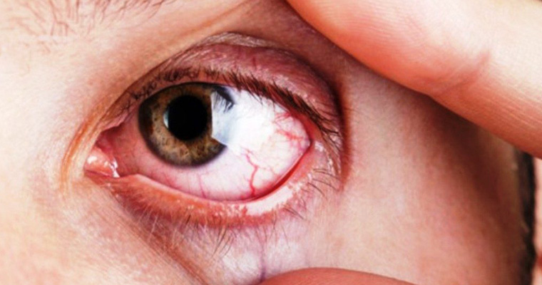 Glaucoma, una enfermedad silenciosa que causa ceguera irreversible