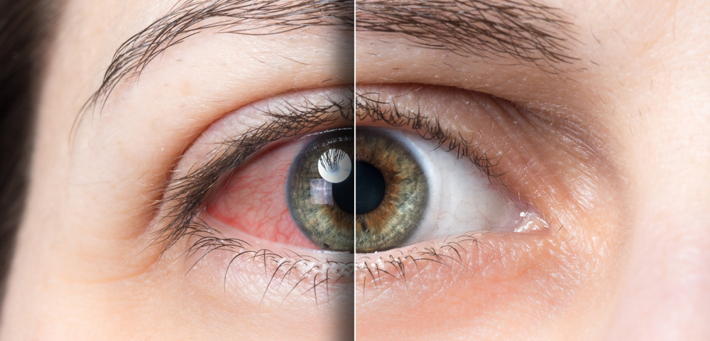 Síndrome del ojo seco: Descubre los síntomas de esta enfermedad