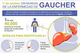 Cinco señales para identificar la enfermedad de Gaucher
