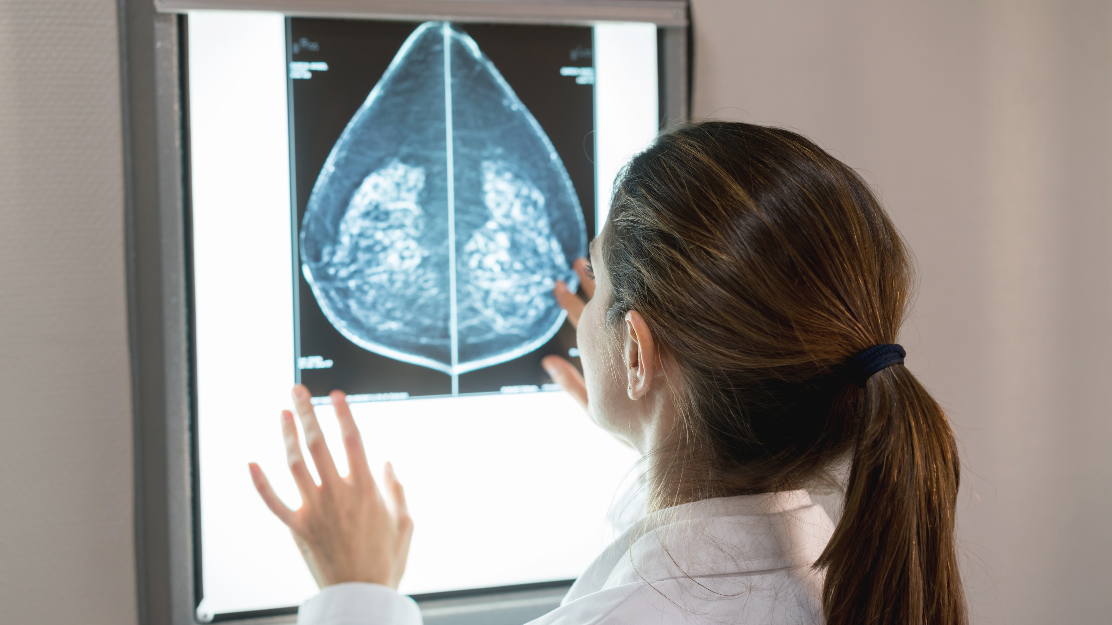 Luego del proceso de la quimioterapia en un cáncer de mama, podría ocurrir un rebrote y o una recaída, sostiene médico oncólogo.