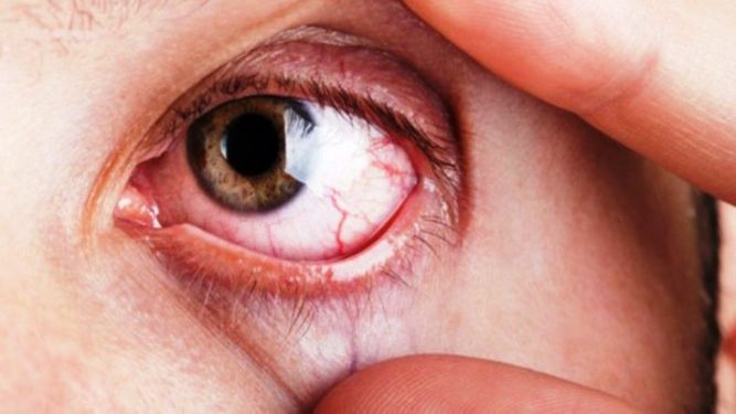 CONOCE LOS NUEVOS AVANCES EN EL TRATAMIENTO DEL GLAUCOMA