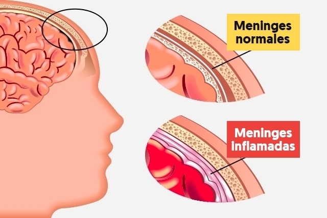 OMS lanza estrategia contra la meningitis para salvar más de 200 mil vidas al año