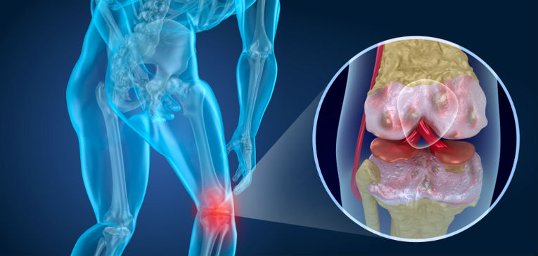 Más de 300 millones de personas padecen de osteoartrosis